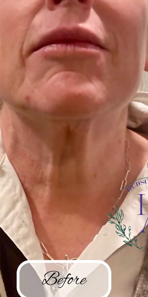 Botox — before