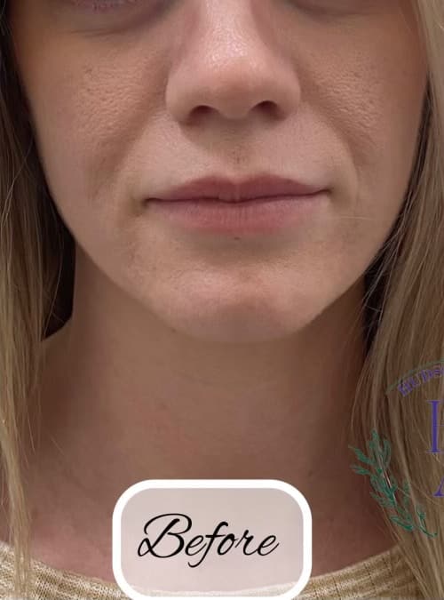 Cheek Fillers — before