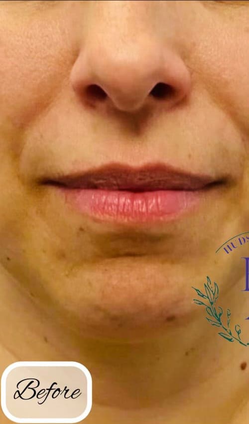 Dermal Fillers — before