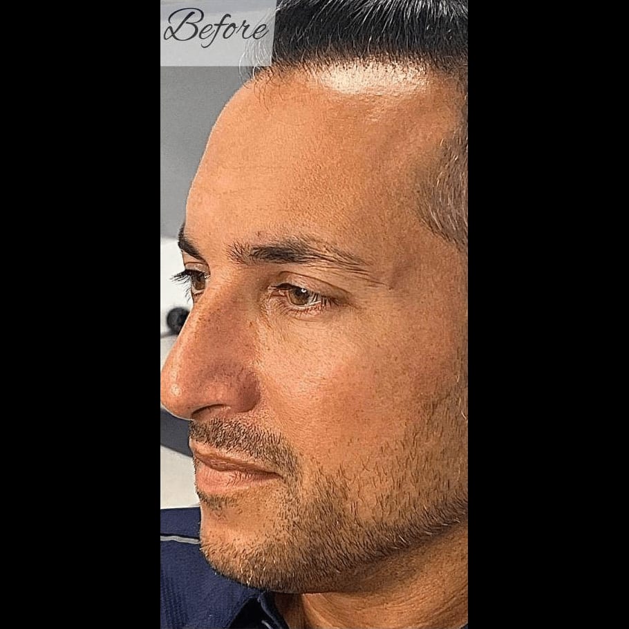 Geneo Balance Facial — before