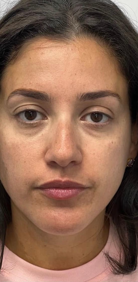 Glo2 Facial — before