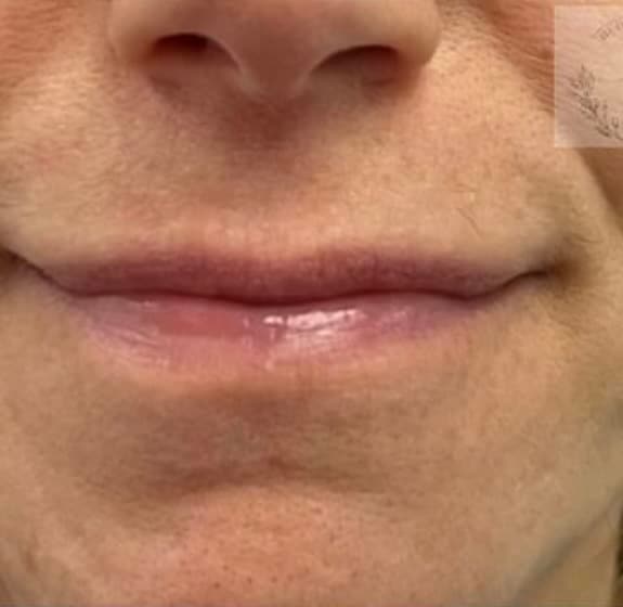 Lip Flip — before