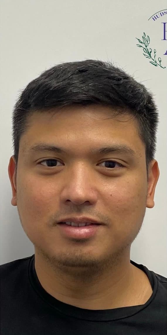 Masseter Botox — before