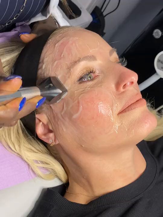 The Forma radiofrequency handpiece gliding over a patient’s cheek