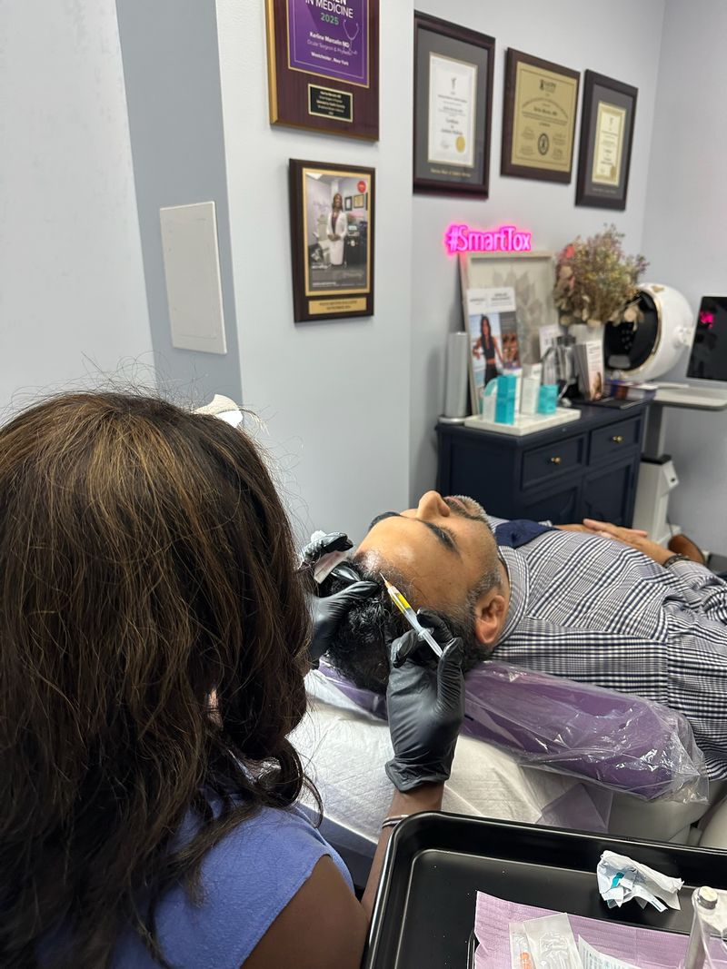 Platelet-rich plasma being injected along a patient’s hairline during PRP hair restoration at Hudson Aesthetics MD