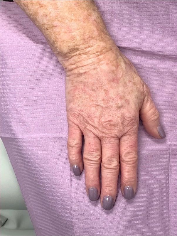 The same patient’s hand after Lumecca IPL at Hudson Aesthetics MD