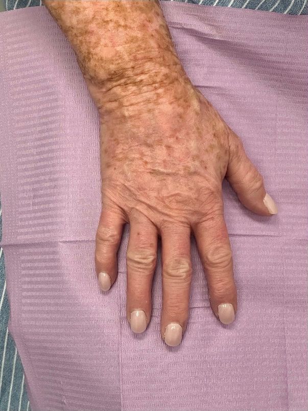 A patient’s hand before Lumecca IPL at Hudson Aesthetics MD