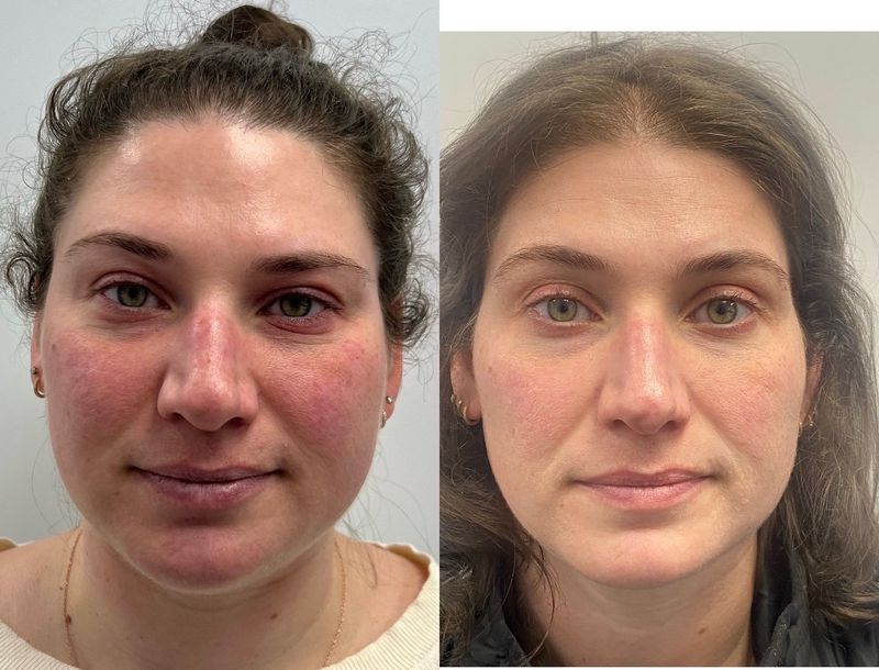 A patient’s face before and after Lumecca IPL for facial redness at Hudson Aesthetics MD