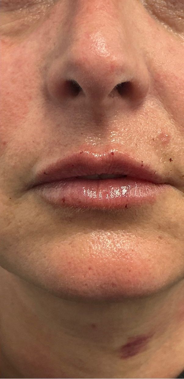 The same patient’s lips after a gradual lip filler build at Hudson Aesthetics MD