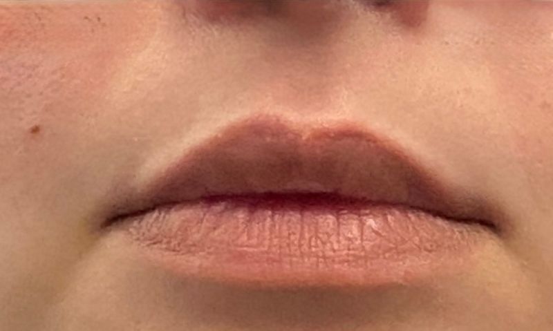 A patient’s lips before a lip filler treatment at Hudson Aesthetics MD