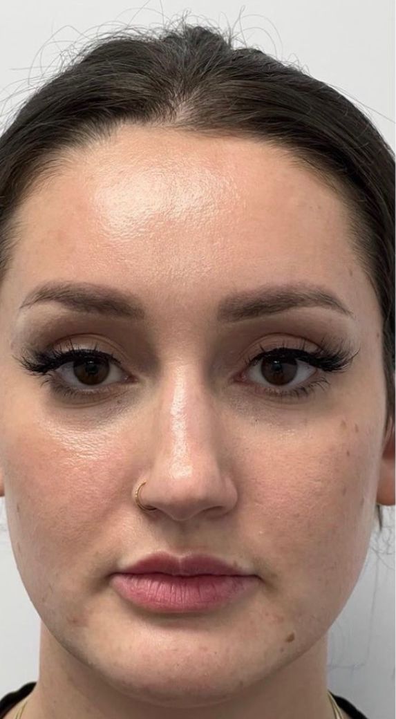 A patient’s face before masseter neurotoxin injections for facial slimming at Hudson Aesthetics MD