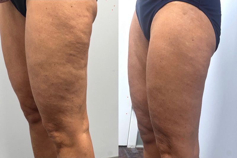 The backs of a patient’s thighs before and after Morpheus8 body treatment at Hudson Aesthetics MD