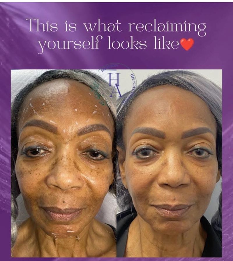 Hudson Aesthetics MD’s card showing a patient before and after Morpheus8 and Moxi at Hudson Aesthetics MD