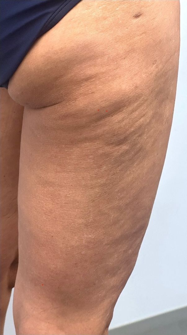 The same patient’s thigh after Morpheus8 body treatment at Hudson Aesthetics MD