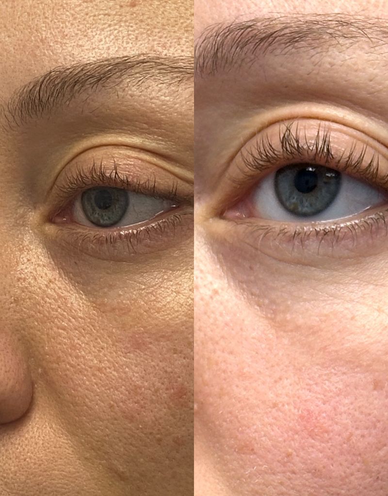 A patient’s eye and cheek before (left) and after (right) Moxi at Hudson Aesthetics MD