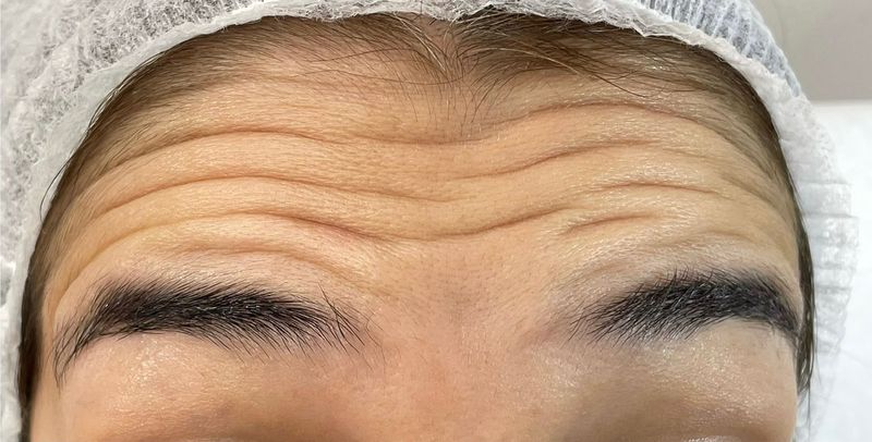 A patient’s forehead lines before neurotoxin injections at Hudson Aesthetics MD