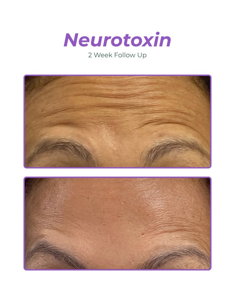 Forehead lines before and two weeks after a neurotoxin treatment at Hudson Aesthetics MD