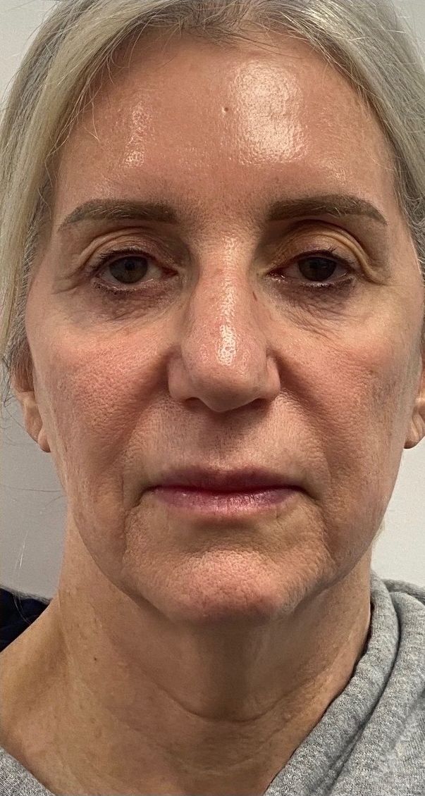 The same patient’s face after Sculptra and Morpheus8 at Hudson Aesthetics MD