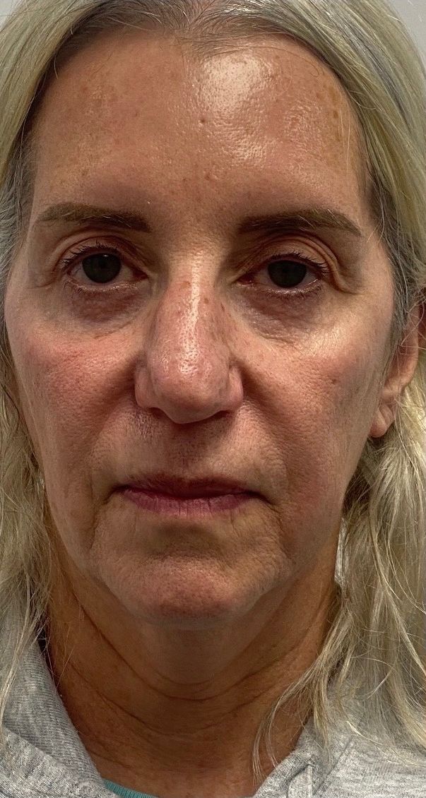 A patient’s face before Sculptra and Morpheus8 at Hudson Aesthetics MD