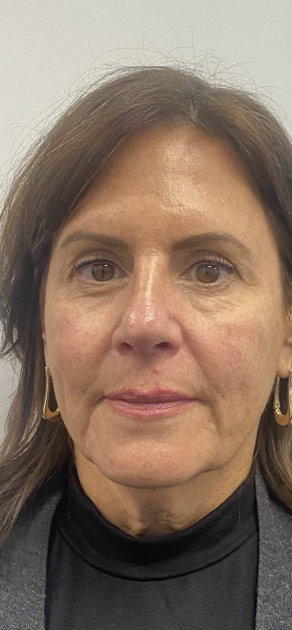 The same patient’s face after Sculptra and Morpheus8 at Hudson Aesthetics MD