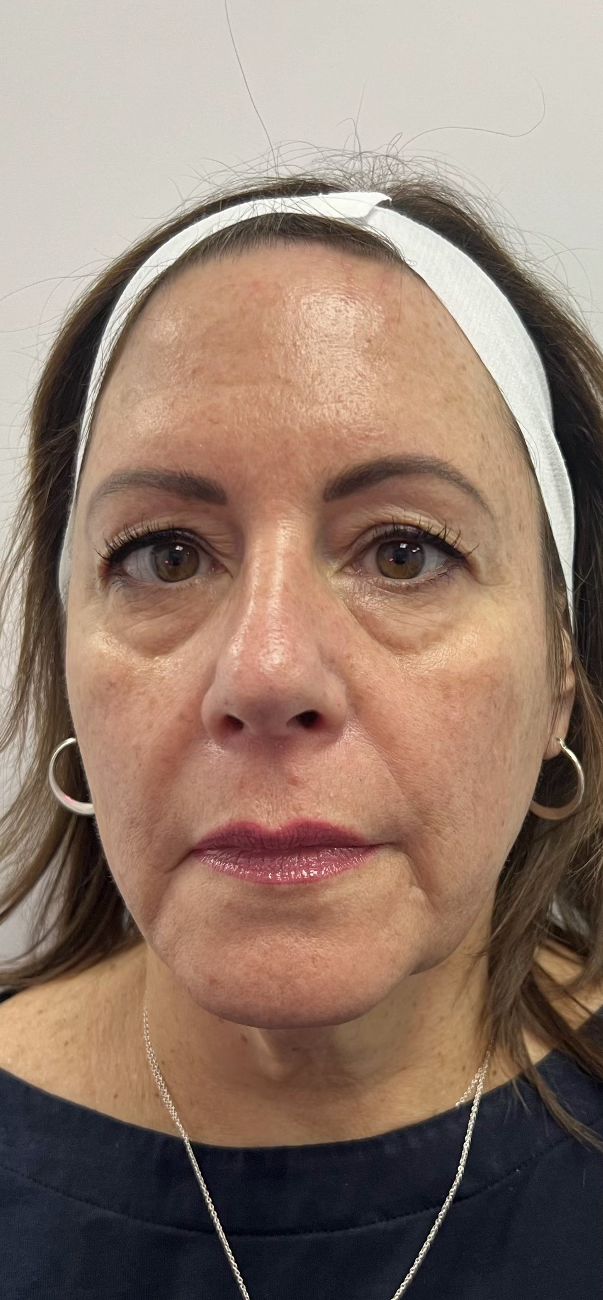 A patient’s face before Sculptra and Morpheus8 at Hudson Aesthetics MD