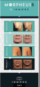 Morphuesfbxdgu Morpheus8 Body